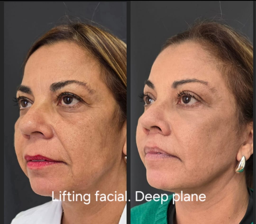 Lifting facial deep plane, foto 1 — antes y después