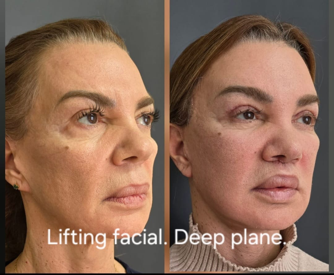 Lifting facial deep plane, foto 3 — antes y después
