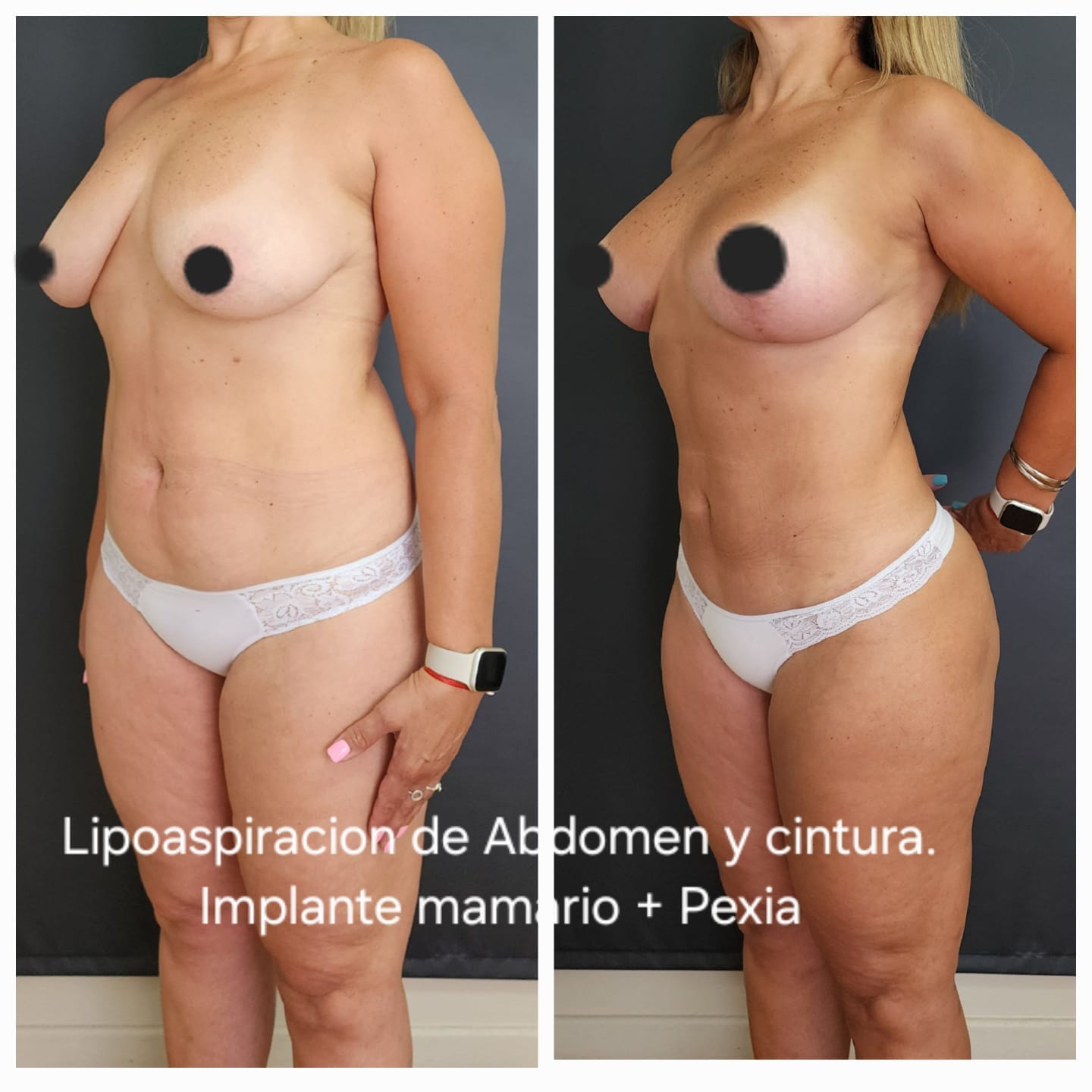 Lipoaspiración de abdomen y cintura, implante mamario y pexia — antes y después