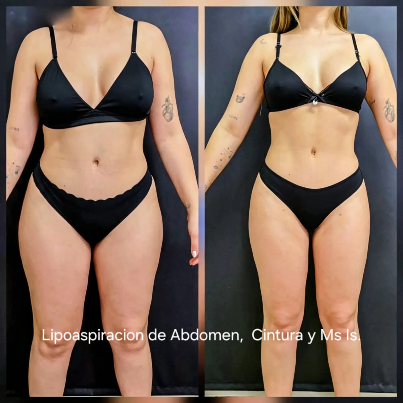 Lipoaspiración, foto 3 — antes y después
