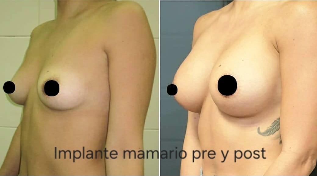 Implante mamario, foto 1 — antes y después