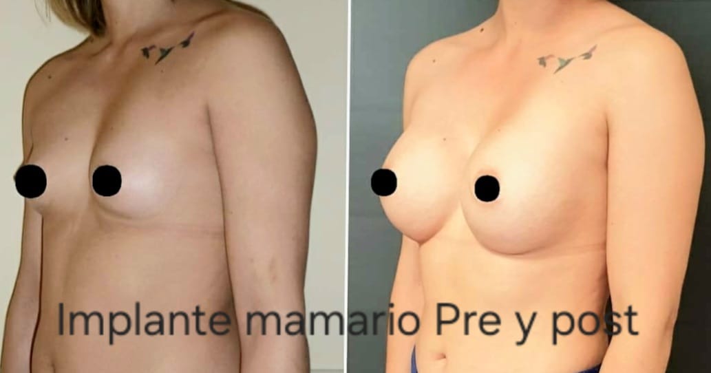 Implante mamario, foto 2 — antes y después